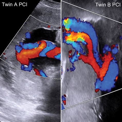 doppler maternaler gefäße|A Radiologist’s Guide to the Performance and。